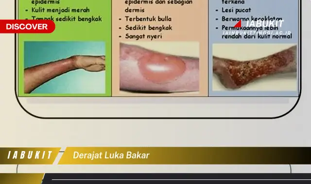 derajat luka bakar