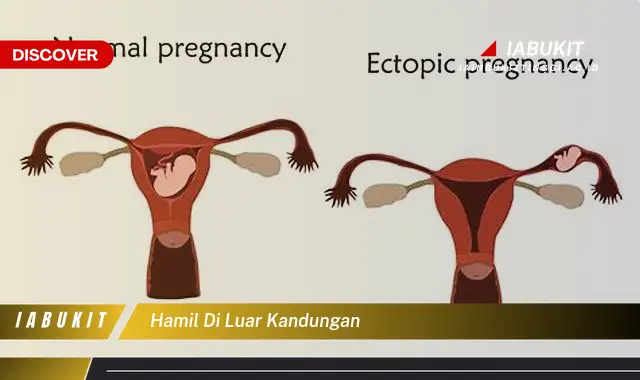 hamil di luar kandungan