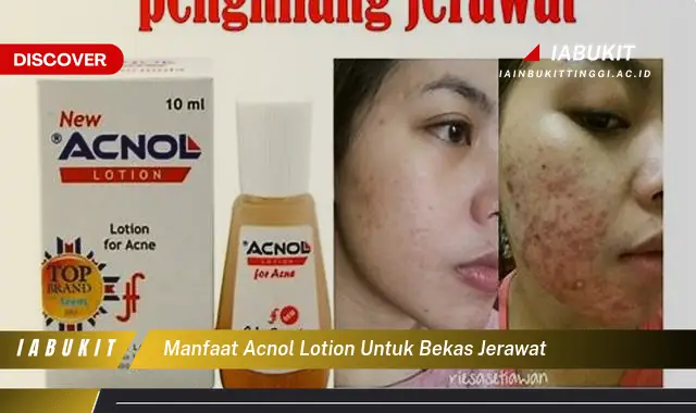 manfaat acnol lotion untuk bekas jerawat