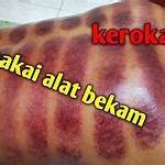 manfaat kerok badan